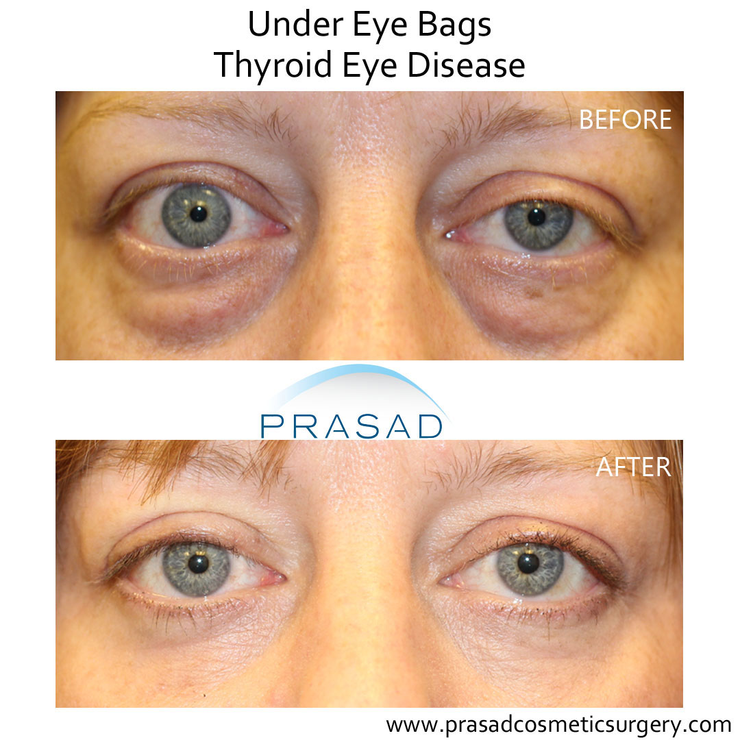 Graves Thyroid Eye Disease Thyroid Eye Disease Treatment TVKD