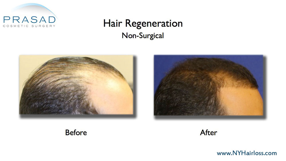 before and after hair loss treatment results - male patient right side view