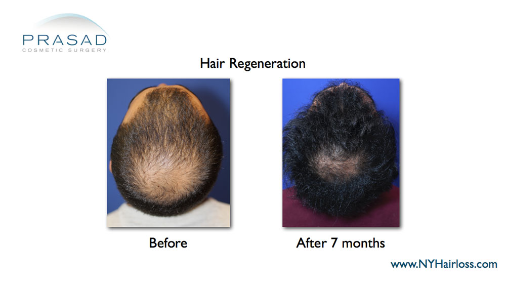 before and 7 months after Hair Regeneration for male pattern hair loss