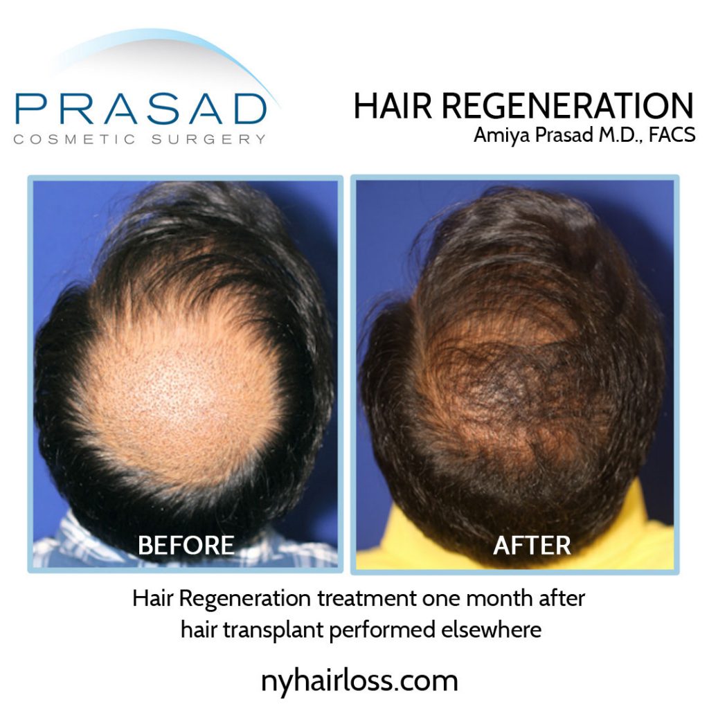 improvement of hair transplant performed 1 month after surgery with hair regeneration results shown after 7 months