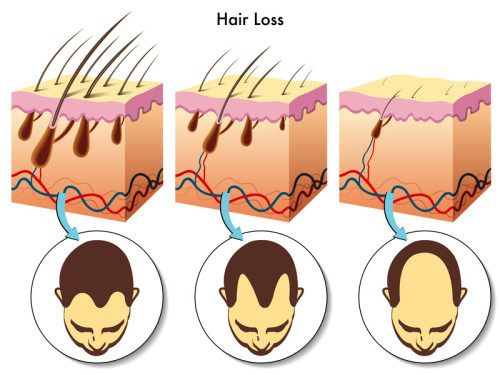 stages of Hair loss process illustration