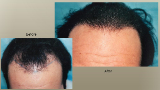 before and after Hair Transplant surgery