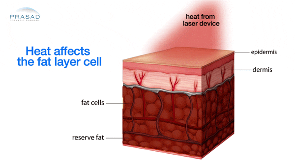 heating device on skin illustration