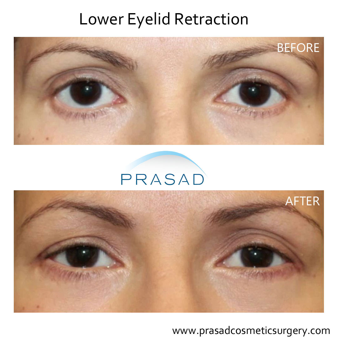 Transconjunctival Blepharoplasty Eyelid surgery New York City
