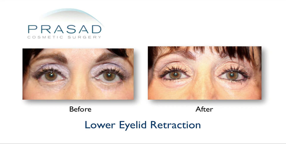 lower eyelid retraction surgery recovery