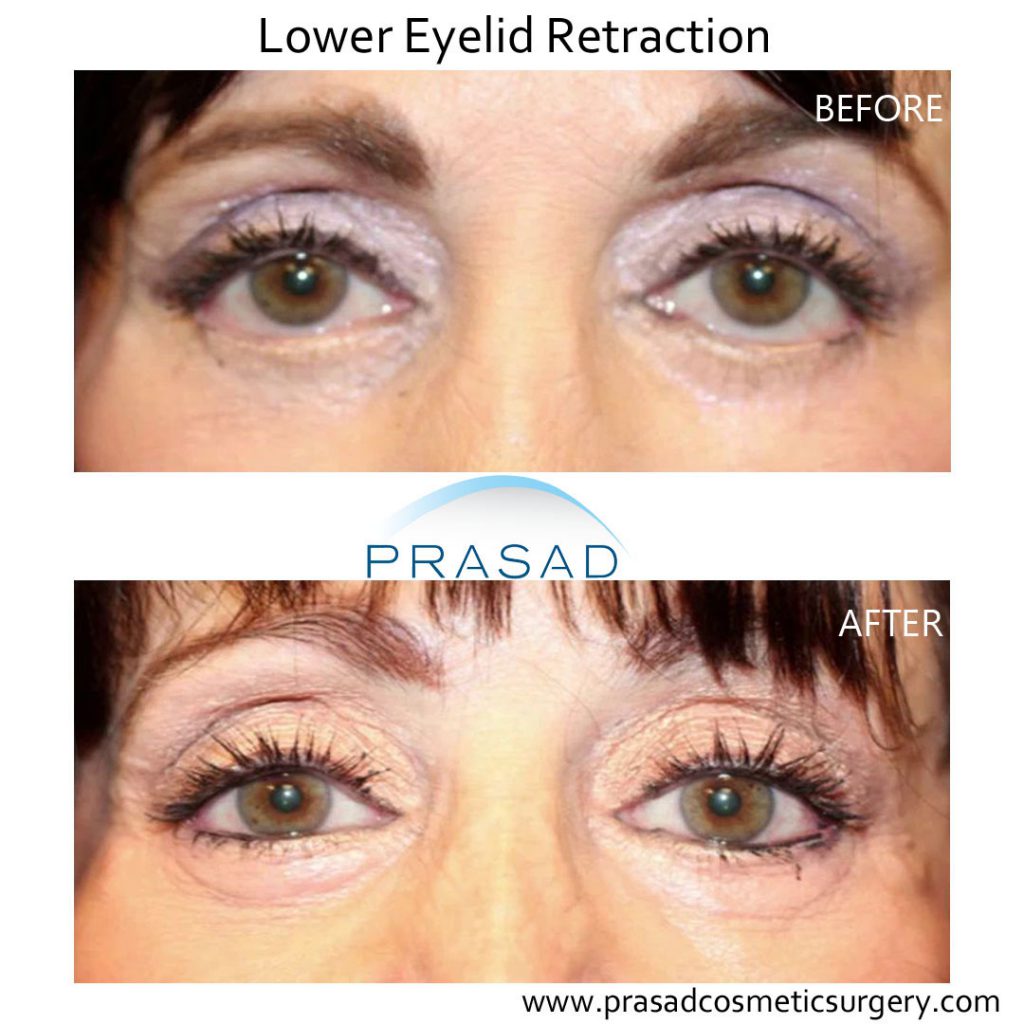 before and after Lower Eyelid Retraction surgery - blepharoplasty revision before and after - female patient