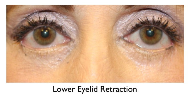 lower eyelid retraction example - older female