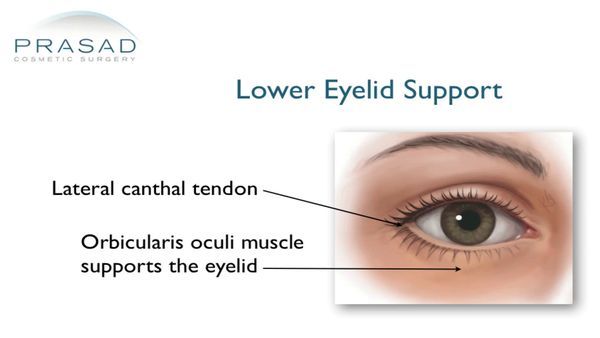 lower eyelid support illustration
