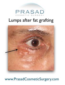 Under Eye Fat Transfer: Possible Complications & Safer Alternative