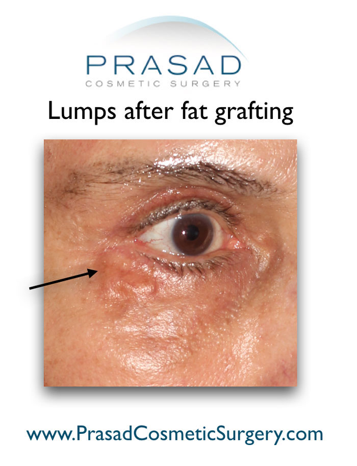 lumps after under eye fat transfer