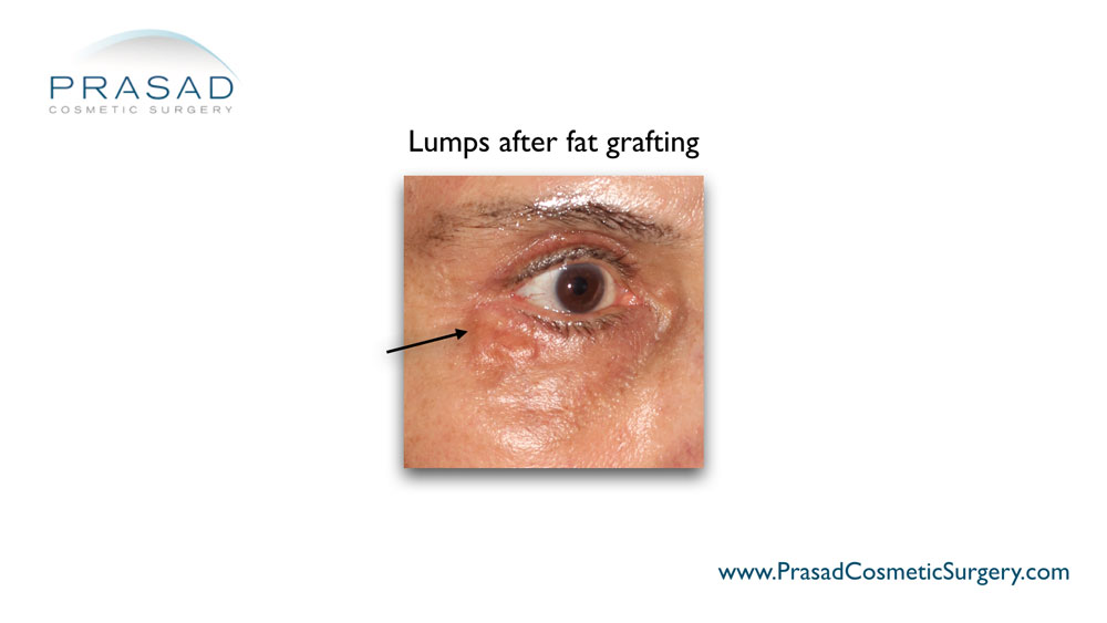 lumps after fat grafting illustration