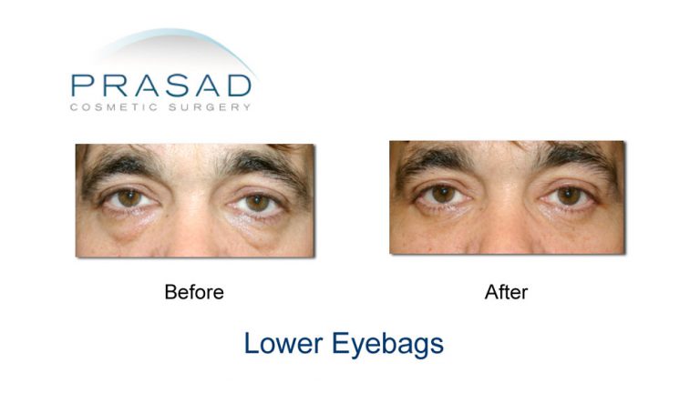 Transconjunctival Blepharoplasty | Eyelid surgery - New York City