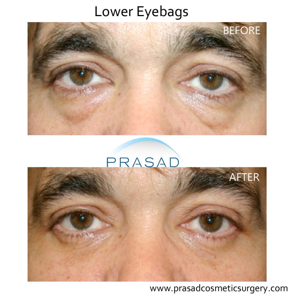 before and after transconjunctival blepharoplasty on male patient