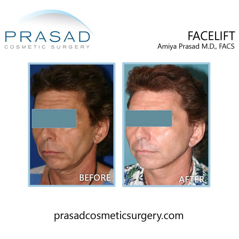 before and after plastic surgery male patient
