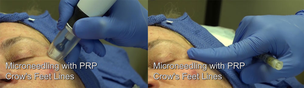 Microneedling with PRP for Crow's Feet Lines application