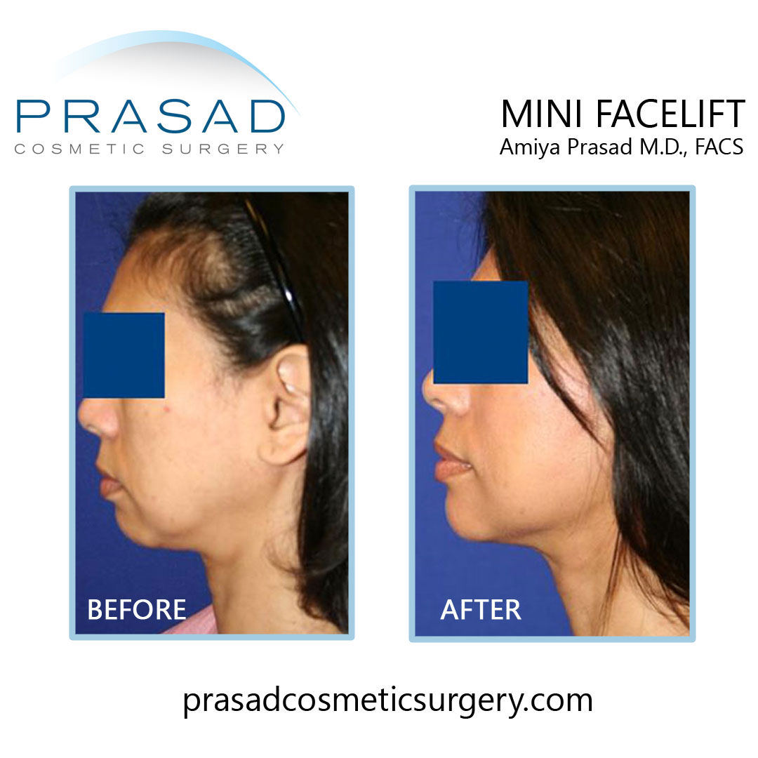 mini facelift before and after results