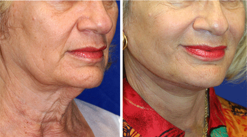 before and after necklift rejuvenation patient - 62 yrs old female patient