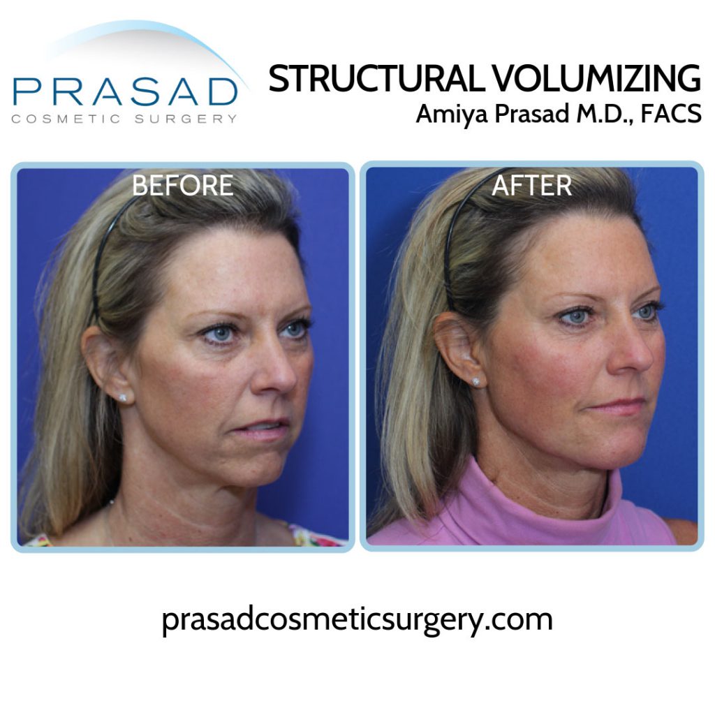 Ultra Lift Non Surgical Face Lift, Medical Spa