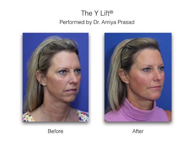 Before and after Y Lift Facelift performed by Dr Amiya Prasad