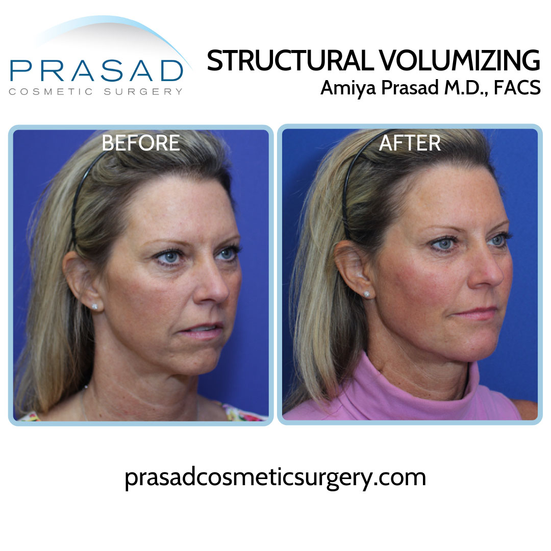 Non-Invasive Facial Contouring Procedures