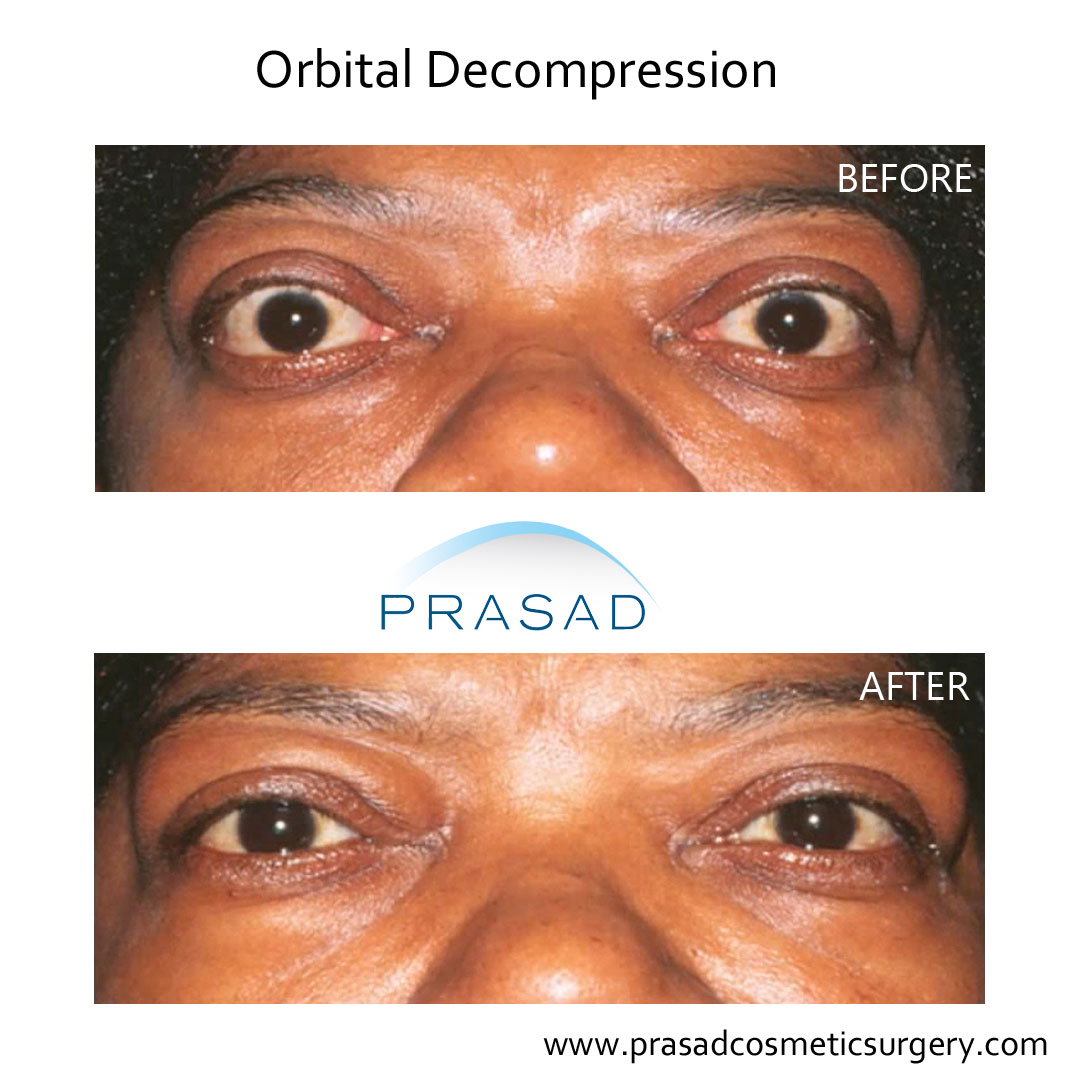 Thyroid Eye Disease Surgery/ Graves Eye Disease Surgery