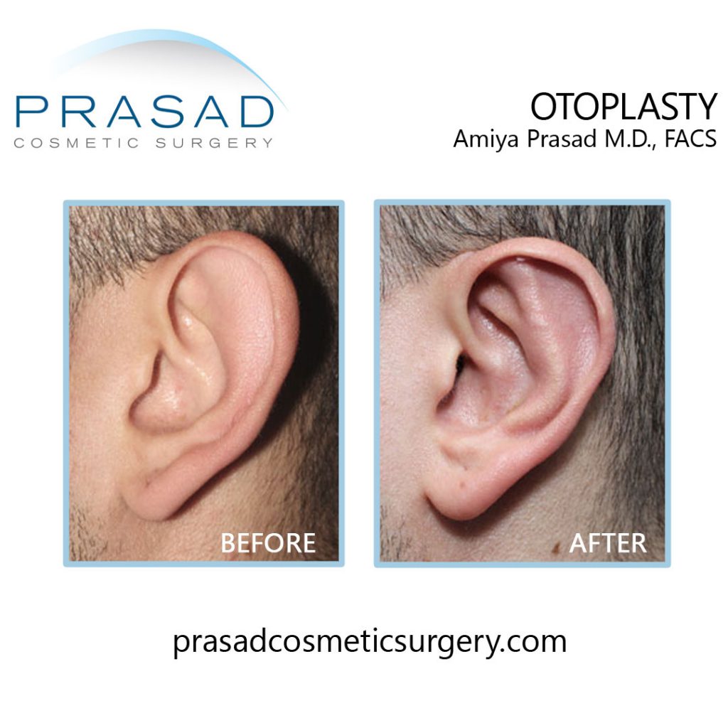 Otoplasty before and after surgery performed by Dr Amiya Prasad, left ear view