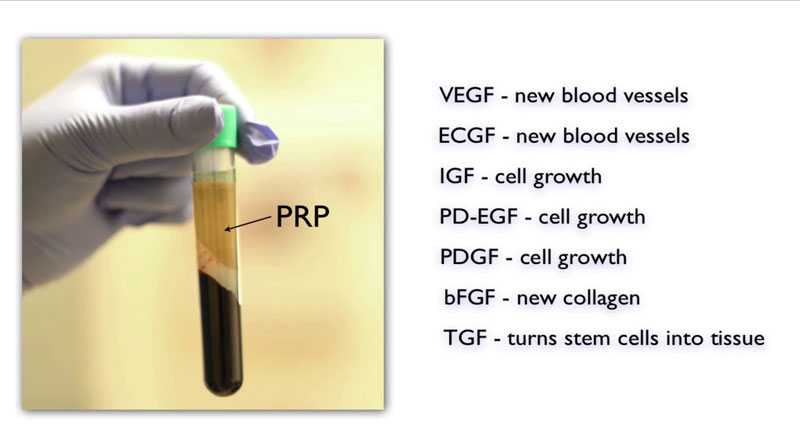 platelet rich plasma growth factors