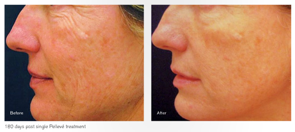 before and after single Pelleve wrinkle treatment