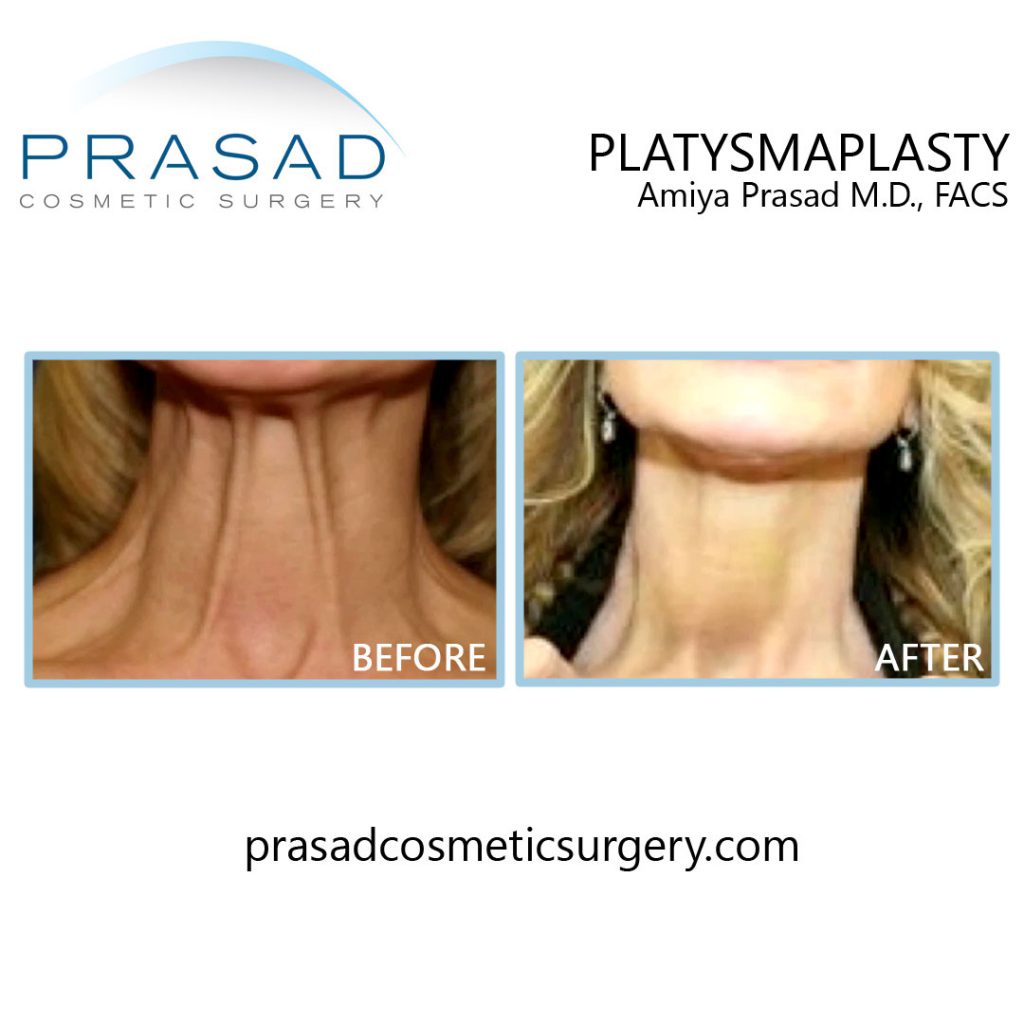 Before and after Platysmaplasty