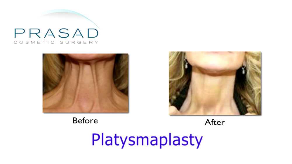 Before and after Platysmaplasty
