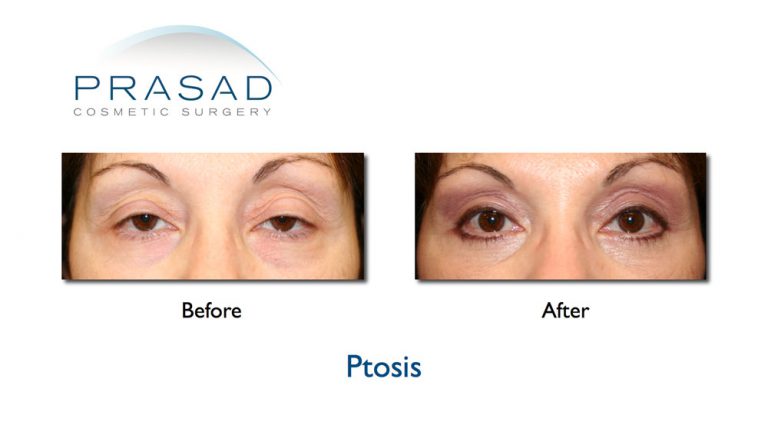 Ptosis Surgery | Droopy eyelid - New York Specialist