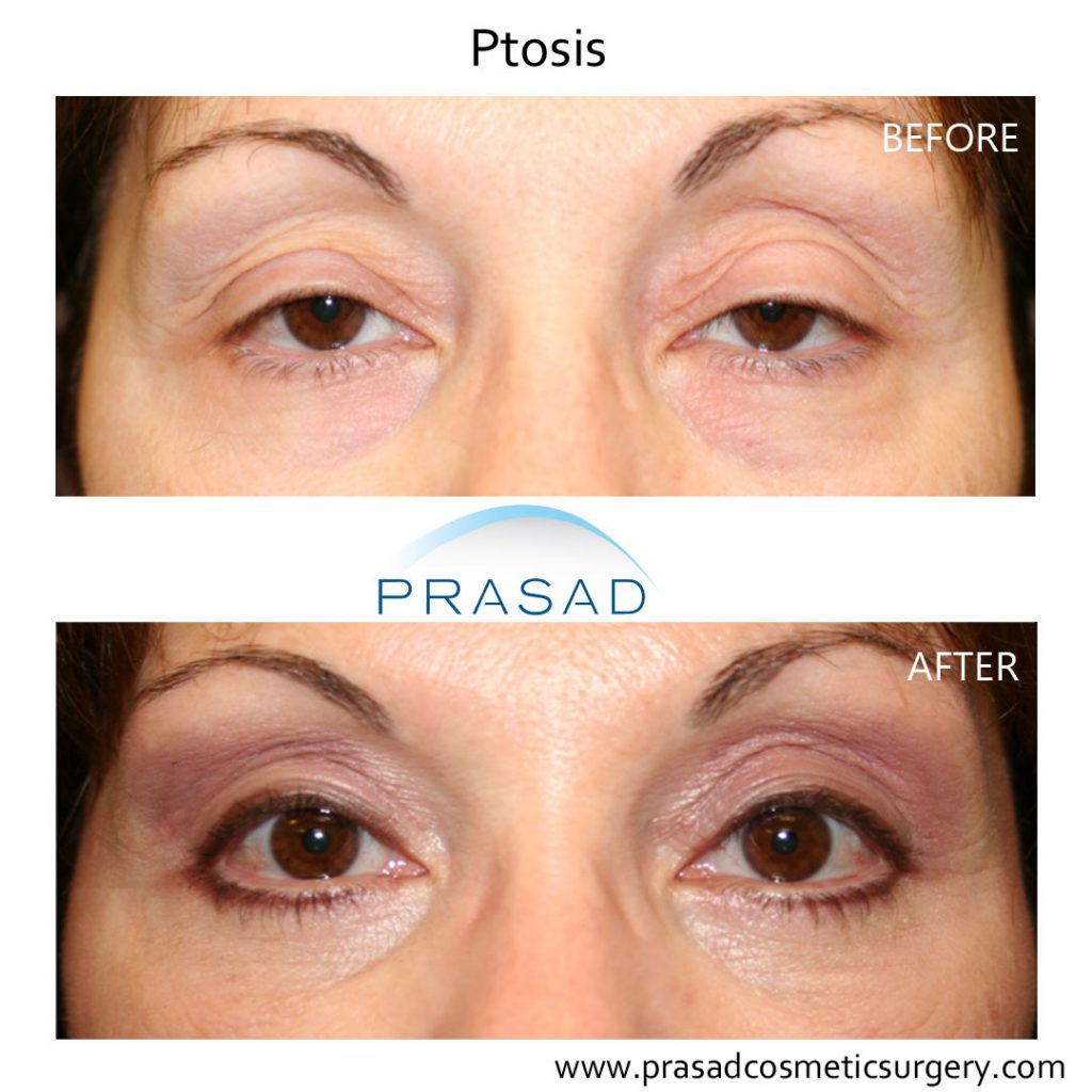 before and after Ptosis surgery - female patient