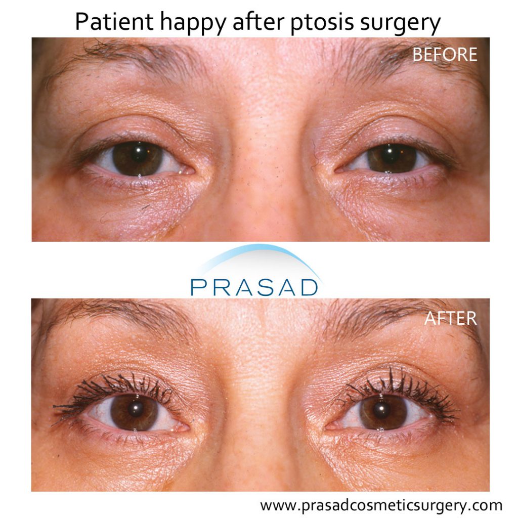 ptosis surgery before and after female