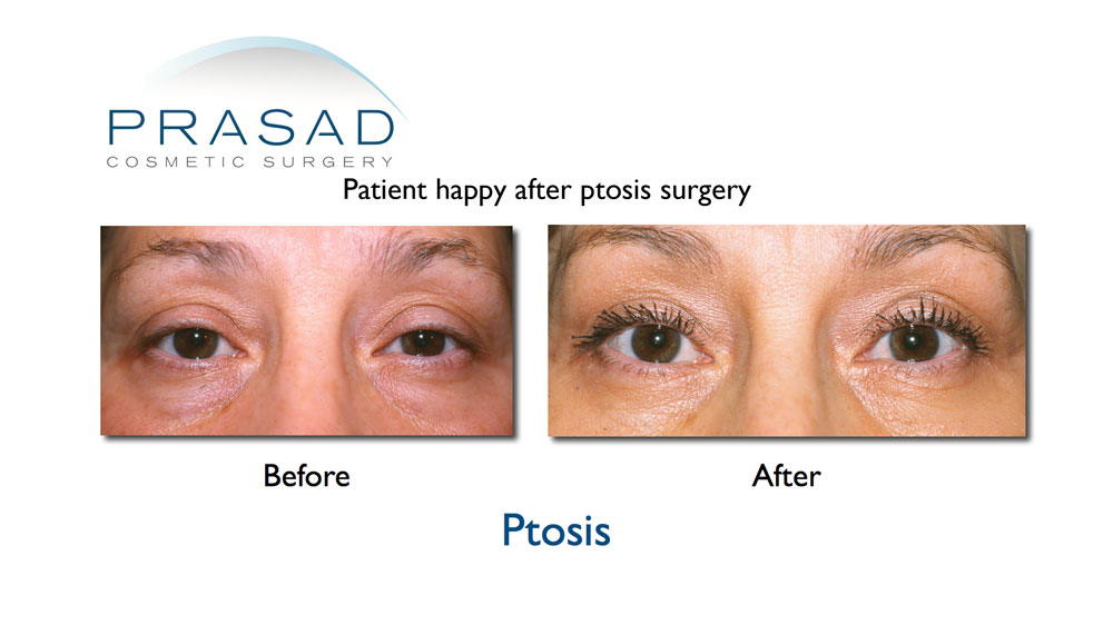 blepharoplasty patient who needed ptosis surgery before and after results