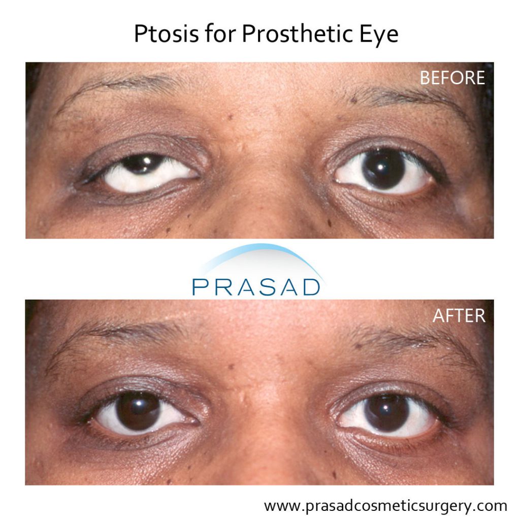 Ptosis cause by a prosthetic eye before and after correction