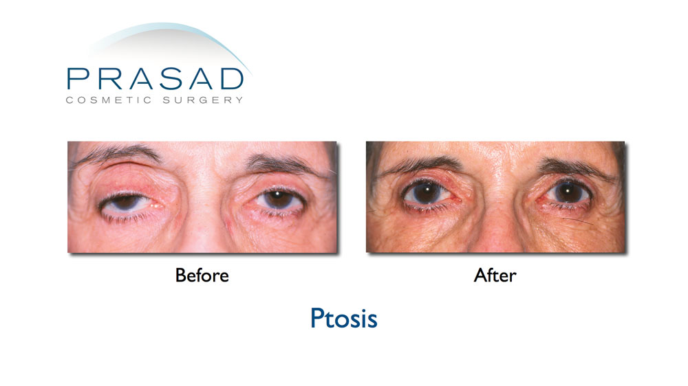 ptosis before and after old