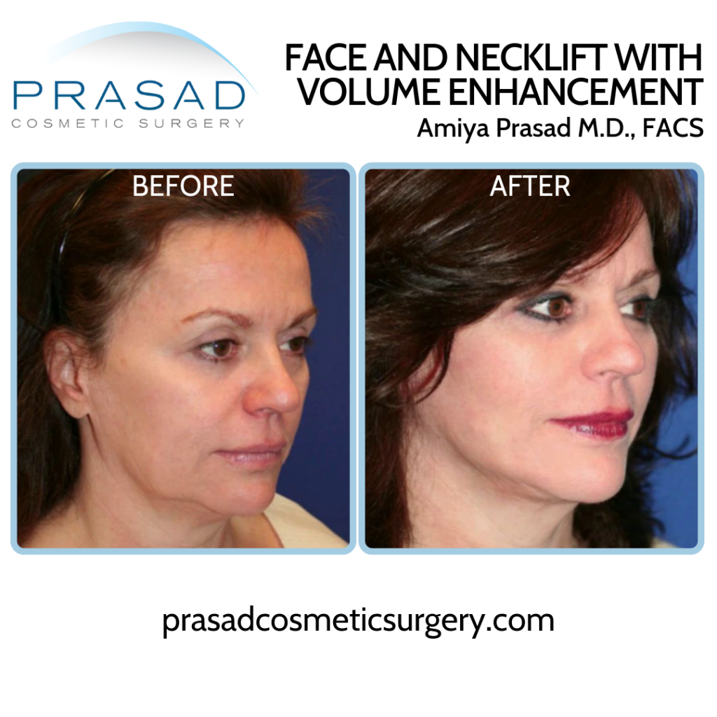 Short Scar Facelift patient Before and After results - three-quarter view