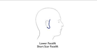 Short Scar Facelift incision diagram