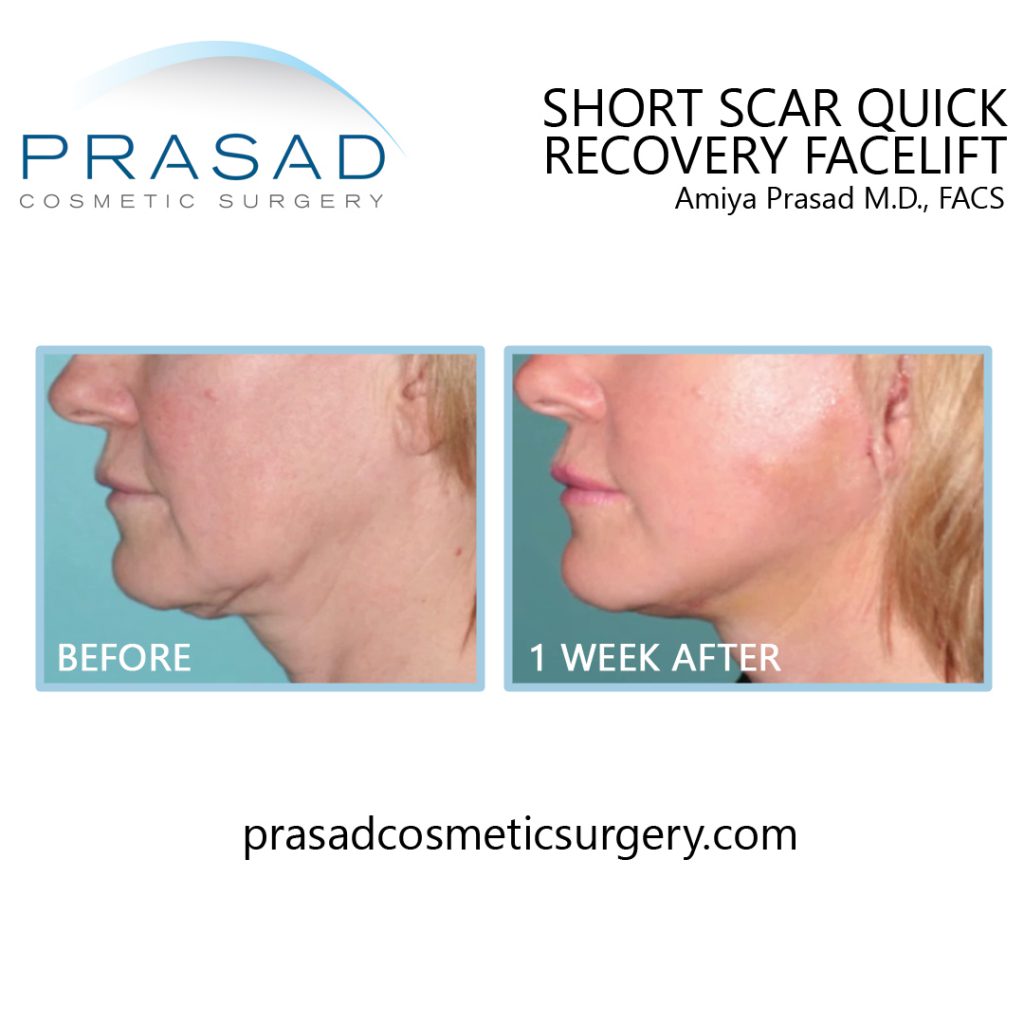 before and 1 week after Short Scar Quick Recovery Facelift