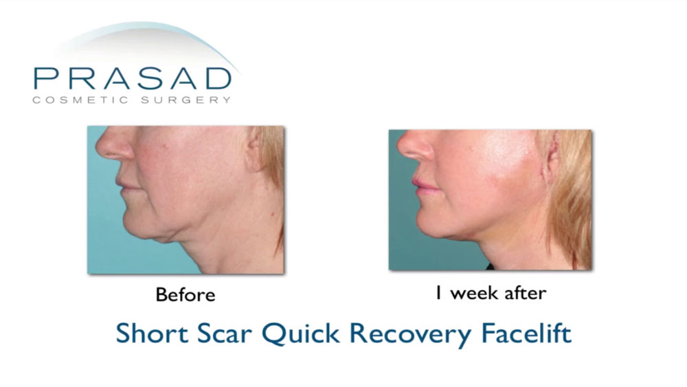 before and 1 week after Short Scar Quick Recovery Facelift