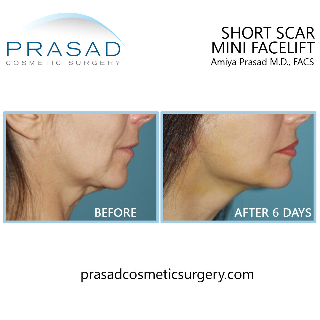 short scar mini facelift before and after