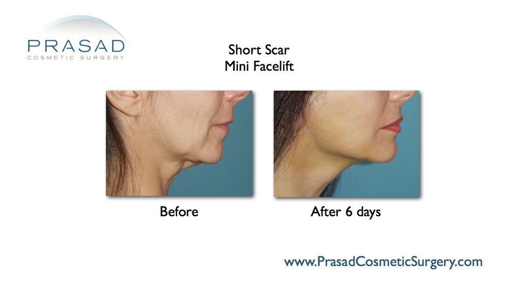 short scar mini facelift before and after
