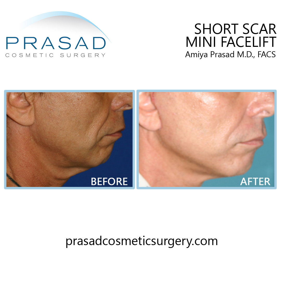short scar mini facelift before and after male patient