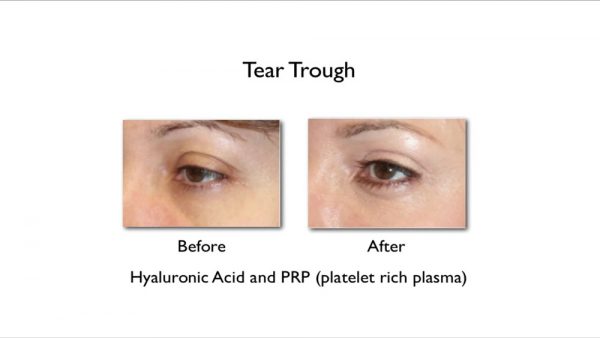 Under Eye Filler for Hollow Eyes, Tear Troughs and Eye Bags