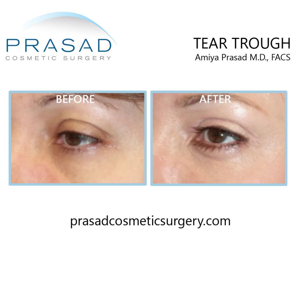 tear trough filler before and after results