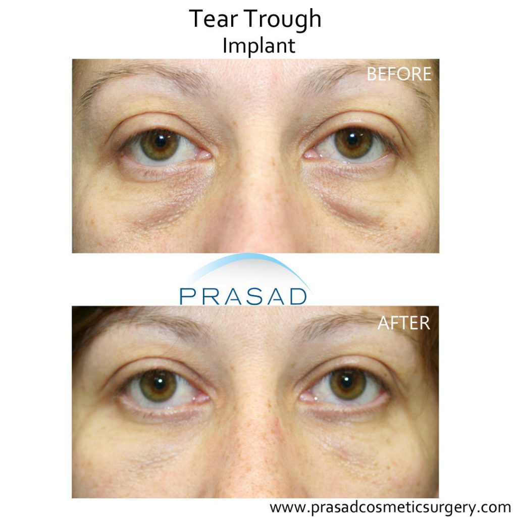 hollow under eyes treatment tear trough implant before and after