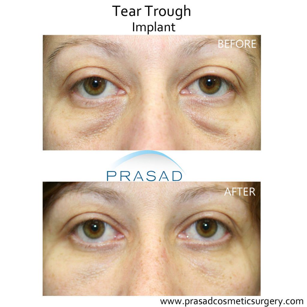 Tear Trough Implants for Hollow Under Eyes New York