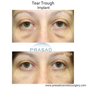 What is the Best Treatment for Under Eye Hollows? | Dr. Prasad Blog