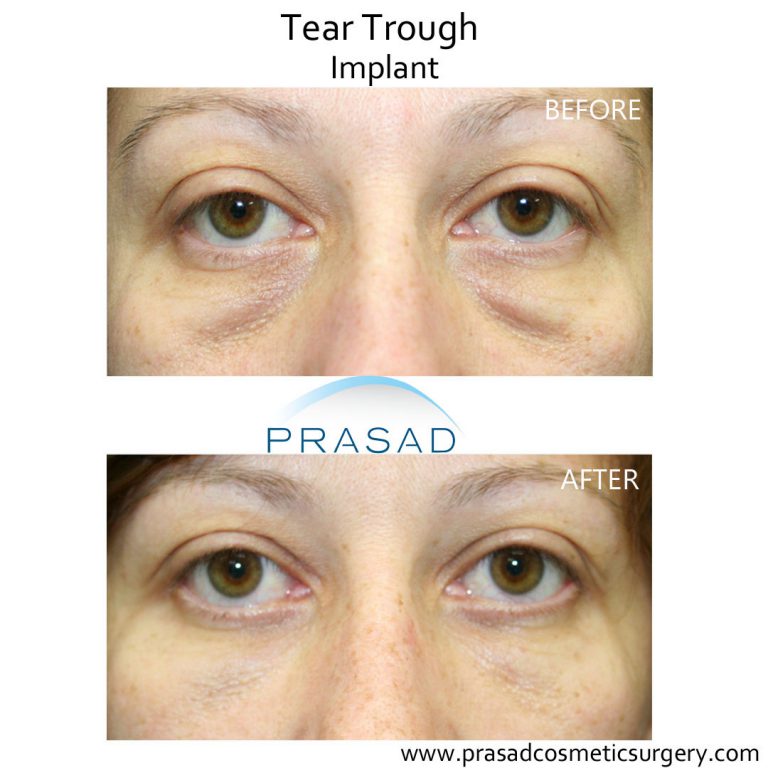 What is the Best Treatment for Under Eye Hollows? | Dr. Prasad Blog