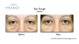 Tear Trough Implants for Hollow Under Eyes | New York